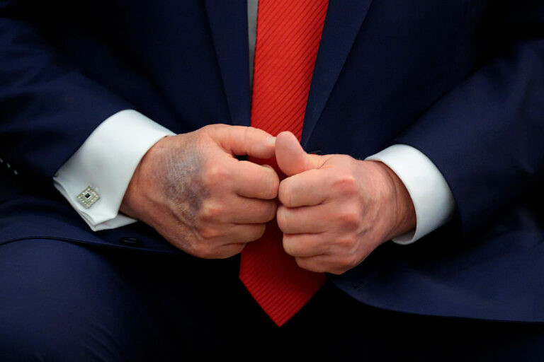 What Is Up With Trump's Bruised Hands? 4